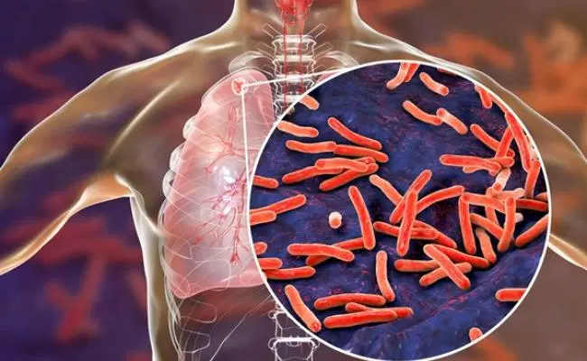 Crecimiento alarmante de tuberculosis en Perú